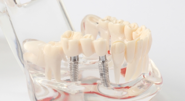 健全なお口を守るインプラント